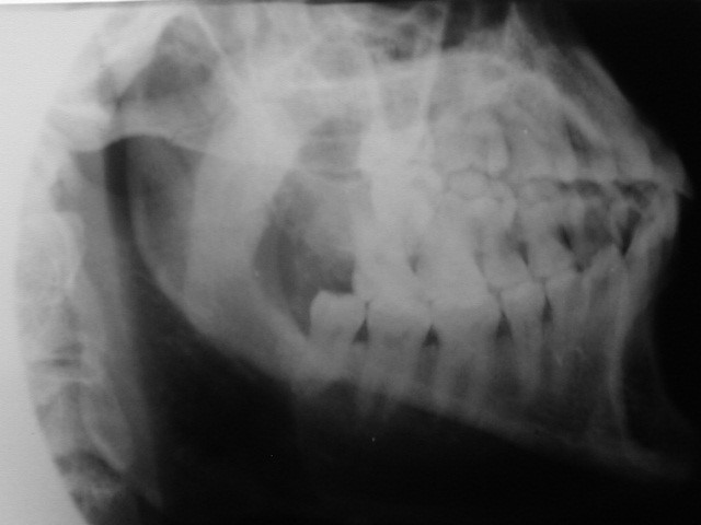 Cuerpo y rama mandibular: